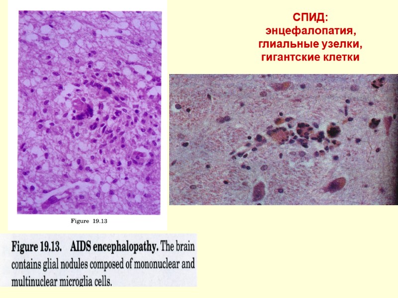 СПИД: энцефалопатия, глиальные узелки, гигантские клетки